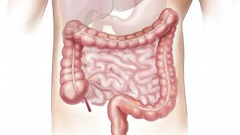 Cáncer de colon Cáncer de colon
