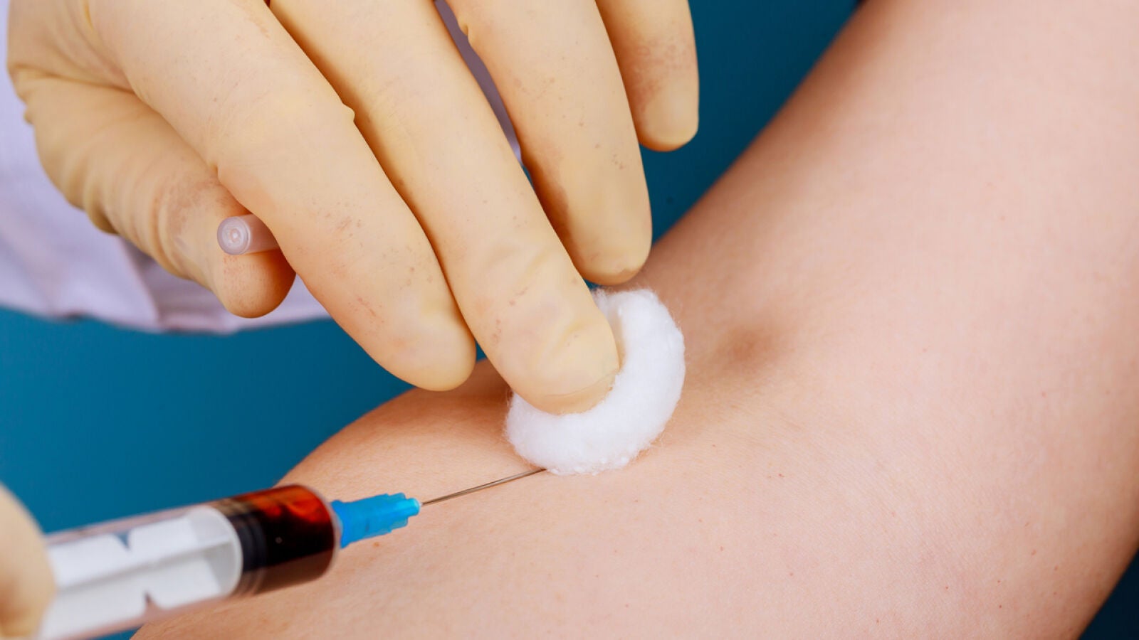 Un análisis de sangre podrá detectar el Alzheimer años antes de que aparezca