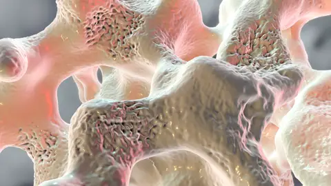 Osteoporosis Osteoporosis