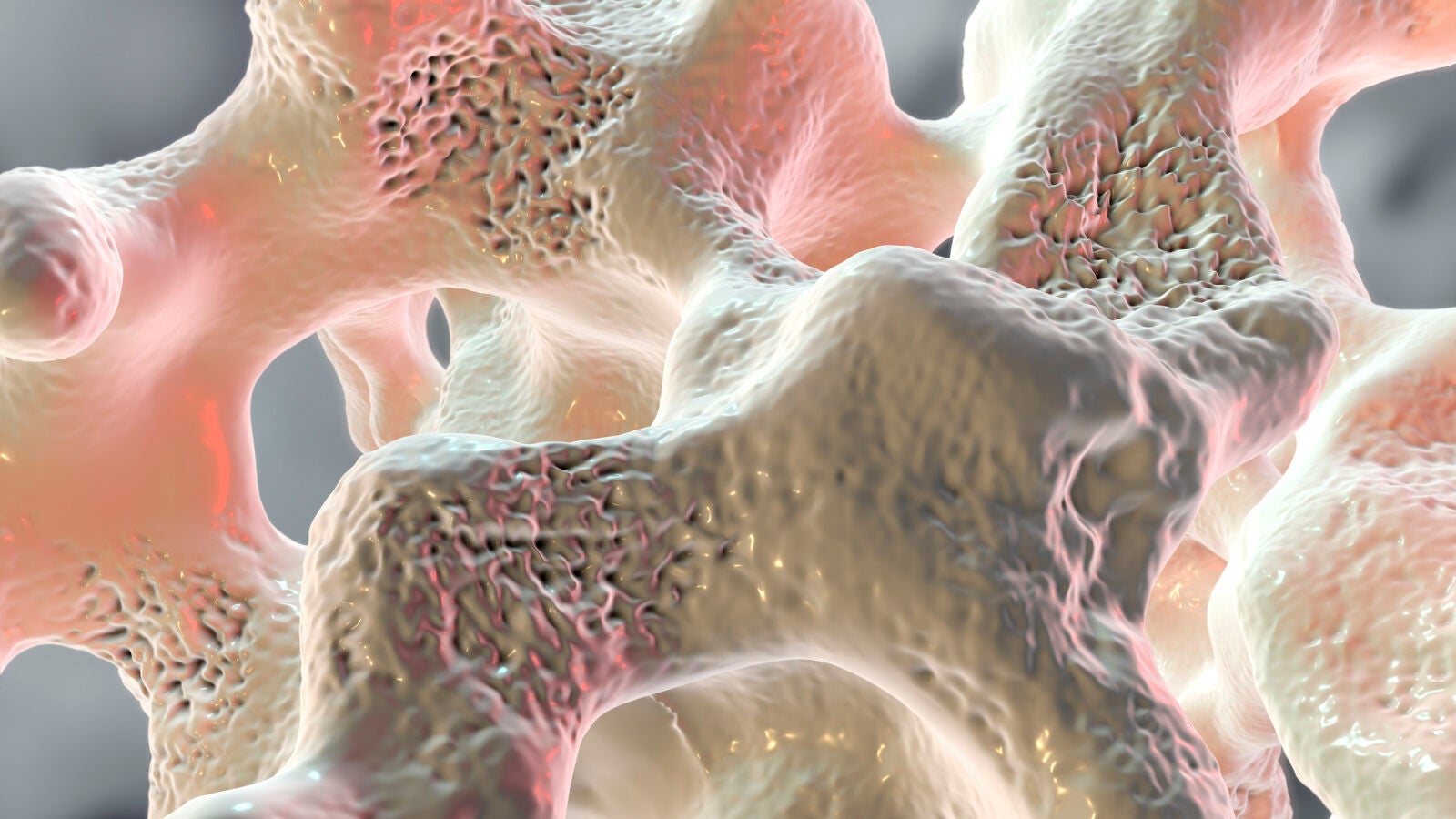 Bifosfonatos para el tratamiento inicial de la osteoporosis en varones y mujeres posmenopáusicas