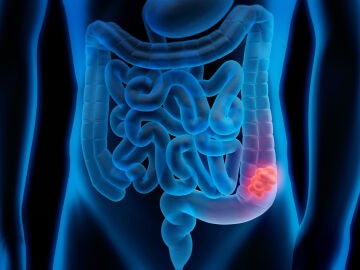 Cáncer de colon