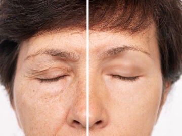 Antes y después de una mujer tras la cirugía de párpados caídos o blefaroplastia