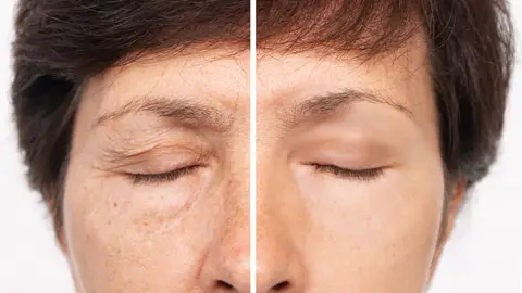 Antes y después de una mujer tras la cirugía de párpados caídos o blefaroplastia Antes y después de una mujer tras la cirugía de párpados caídos o blefaroplastia