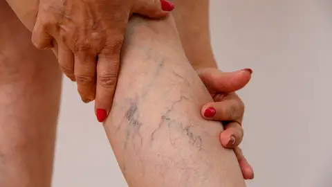 Varices Varices