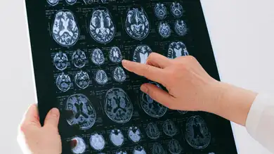 Un estudio consigue revertir con nanopartículas el Alzheimer en ratones Un estudio consigue revertir con nanopartículas el Alzheimer en ratones