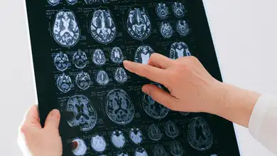 Un estudio consigue revertir con nanopartículas el Alzheimer en ratones Un estudio consigue revertir con nanopartículas el Alzheimer en ratones