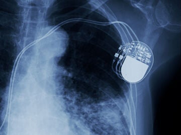 Radiografía de una persona con marcapasos