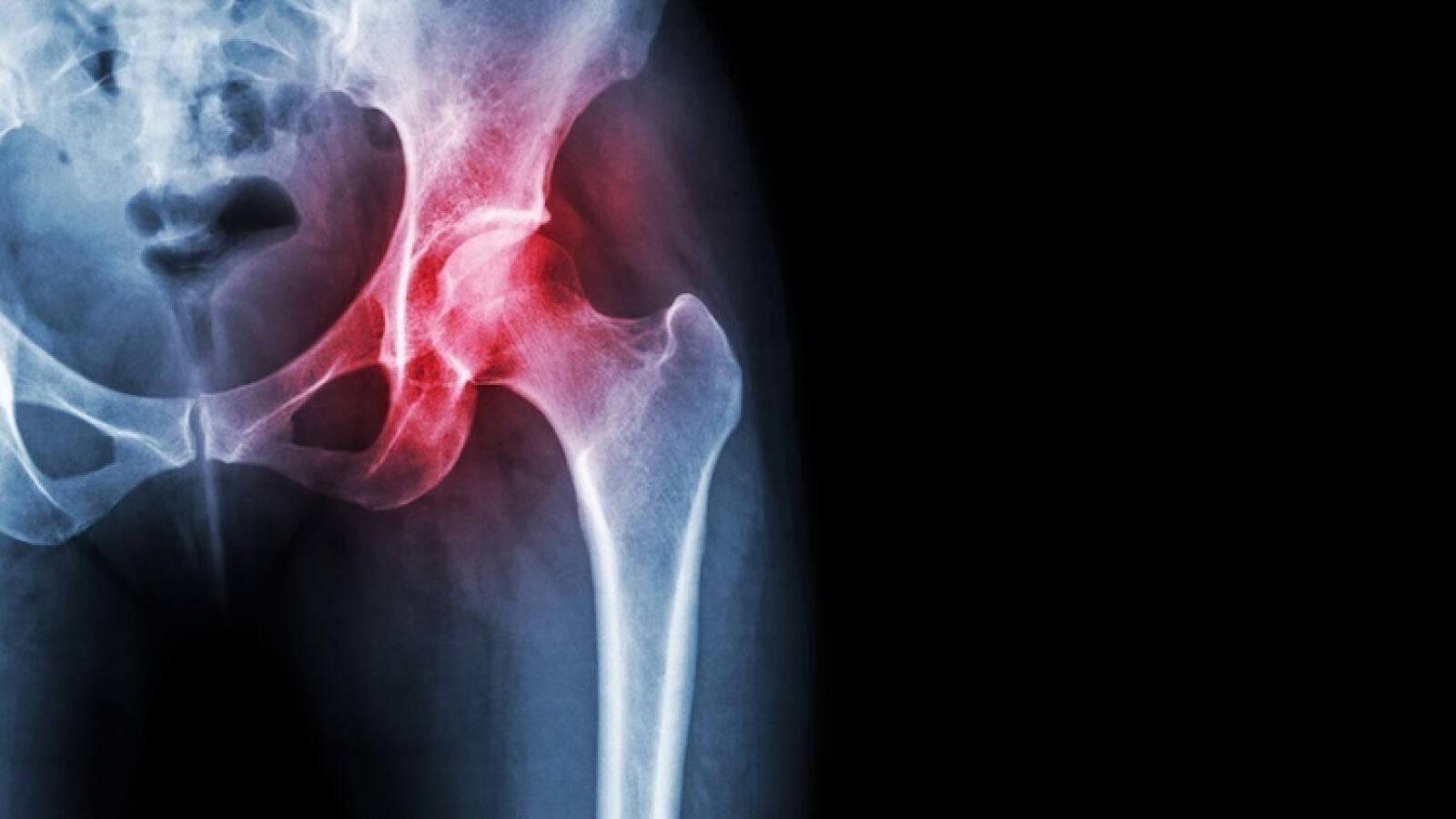 Fracturas por fragilidad: Sociedades científicas y pacientes quieren un consenso en el tratamiento y prevención