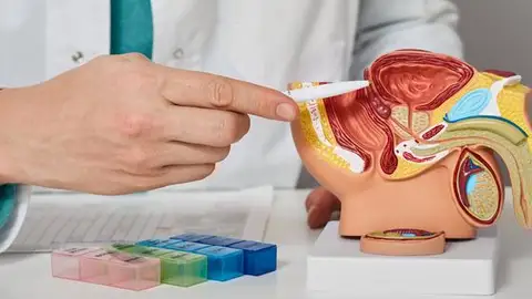 Los casos de cáncer de próstata se duplicarán para 2040 Modelo anatómico del sistema reproductor masculino