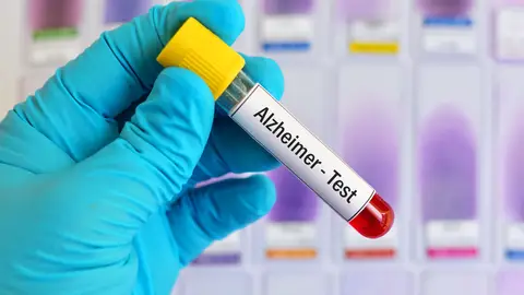 Test genético para saber si desarrollarán Alzheimer en el futuro Test genético para saber si desarrollarán Alzheimer en el futuro