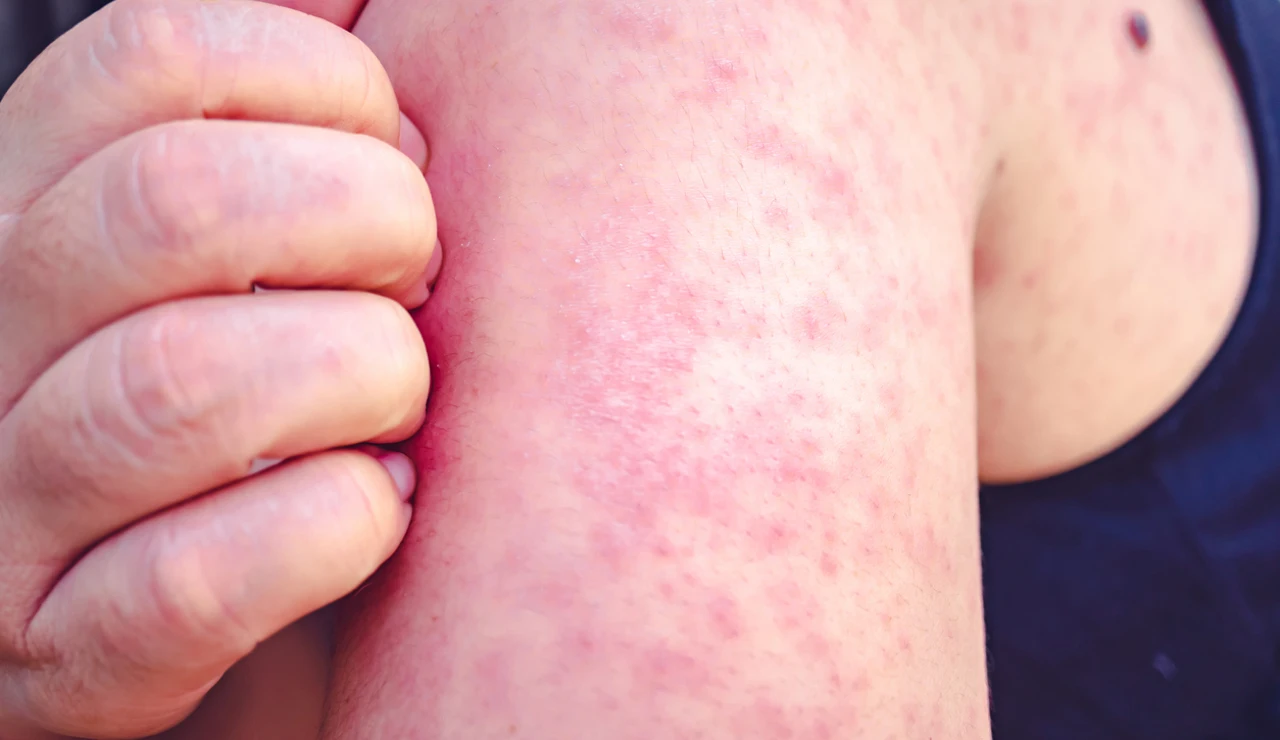 Síntomas del sarampión