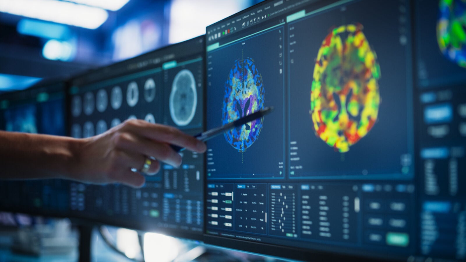El déficit de litio podría ser la clave en la aparición y el tratamiento del Alzheimer