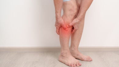 Radióloga alerta de la importancia de reconocer los síntomas de la trombosis para evitar complicaciones irreversibles