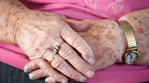 Lentigos solares Lentigos solares