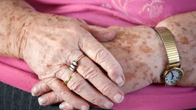 ¿Qué son los lentigos solares y qué tiene que ver con la edad? ¿Qué son los lentigos solares y qué tiene que ver con la edad?