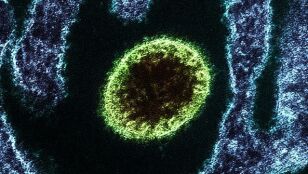 Virus Nipah