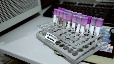 Cáncer de Colon Cáncer de Colon