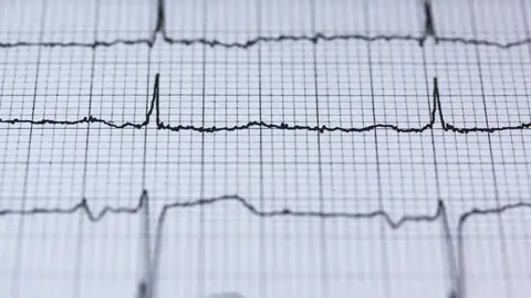 Electrocardiograma Electrocardiograma