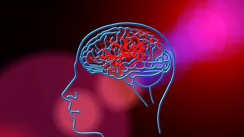 La Inteligencia Artificial permite calcular el riesgo individual de un ictus inteligencia artificial