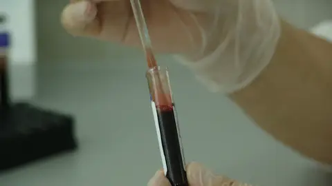 Análisis de sangre para el diagnóstico del virus del VIH Análisis de sangre para el diagnóstico del virus del VIH