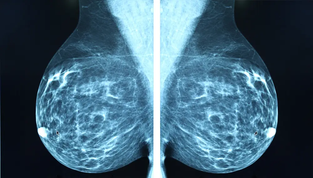 Mamografía para detectar el cáncer de mama