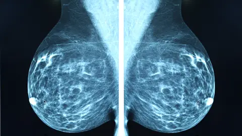 Mamografía para detectar el cáncer de mama Mamografía para detectar el cáncer de mama