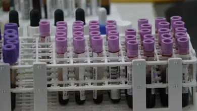 Validan 9 biomarcadores para diagnosticar Alzheimer con análisis de sangre