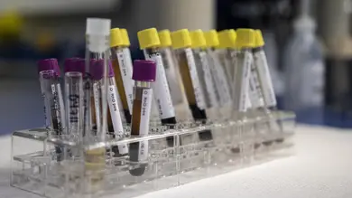 Revelan la eficacia de una prueba de sangre para detectar el cáncer de colon