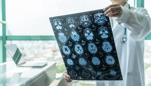 Un estudio arroja dudas sobre un prometedor medicamento contra el alzhéimer