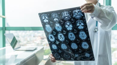 Logran que la quimioterapia penetre en el cerebro contra un tumor mortal