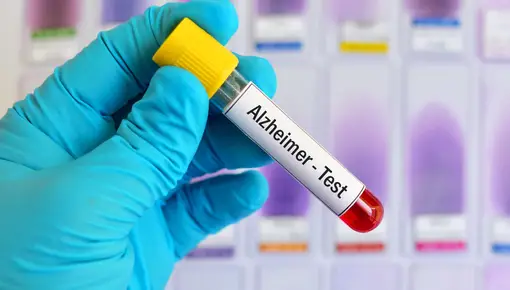 Los antiinflamatorios podrían ser clave como medida contra el Alzheimer
