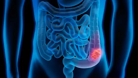 Un análisis de sangre detecta el cáncer de colon en un 99,9% Un análisis de sangre detecta el cáncer de colon en un 99,9%