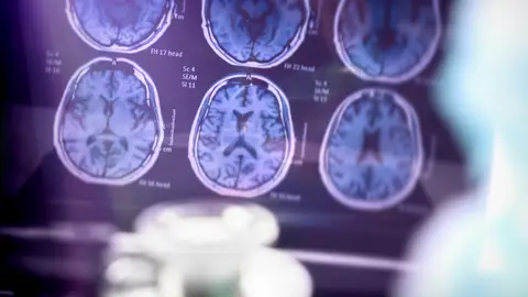 Análisis científico de la enfermedad de Alzheimer en el hospital Análisis científico de la enfermedad de Alzheimer en el hospital