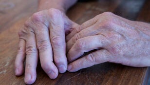 Manos con artritis psori&aacute;sica