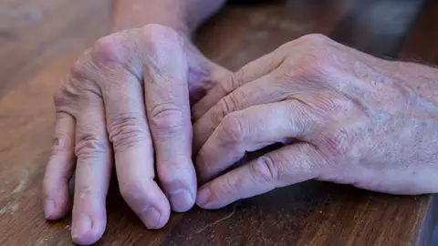 Manos con artritis psoriásica Manos con artritis psoriásica