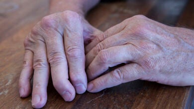 Las mujeres con artritis psoriásica tienen peor respuesta a los tratamientos que los hombres, según experta