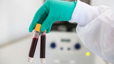 Día Mundial del Mieloma Múltiple: qué es y la importancia de la innovación