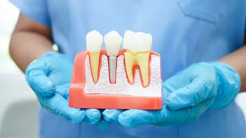 Implantes dentales Implantes dentales