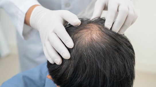 Hombre con alopecia