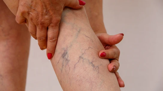 Piernas con varices Piernas con varices