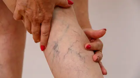 Piernas con varices Piernas con varices