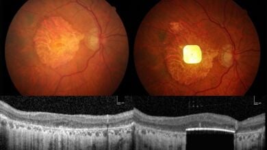 Una prótesis ocular restaura la vista a 27 personas mayores con ceguera irreversible