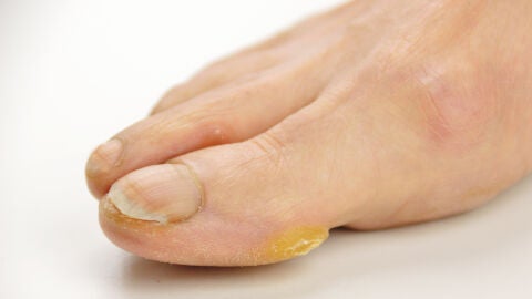 Uña engrosada en un pie