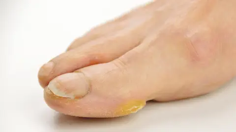 Uña engrosada en un pie Uña engrosada en un pie