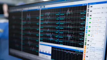 Electrocardiograma Electrocardiograma